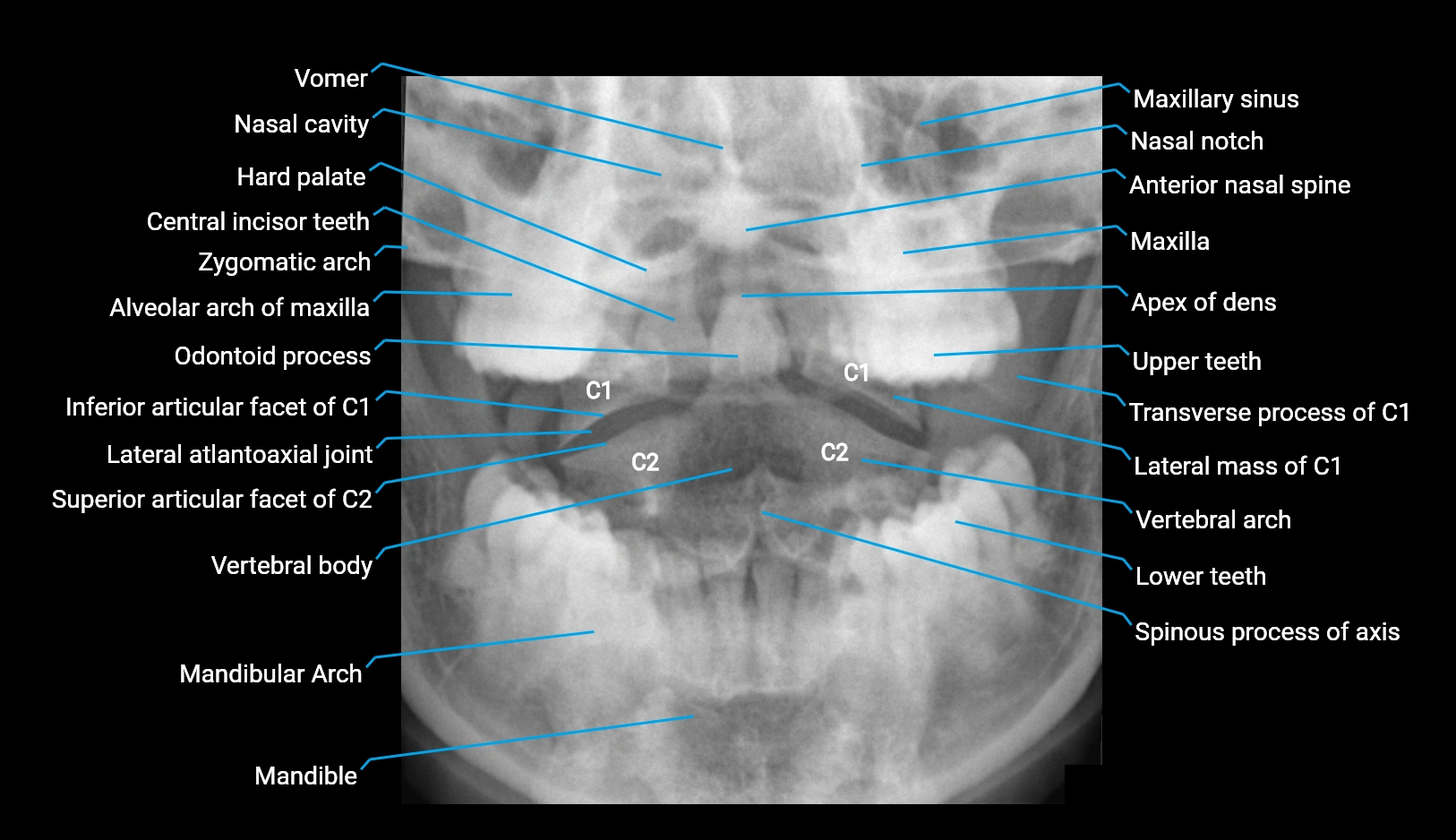 x rayodontoid peg view PA anatomy labelled image.webp